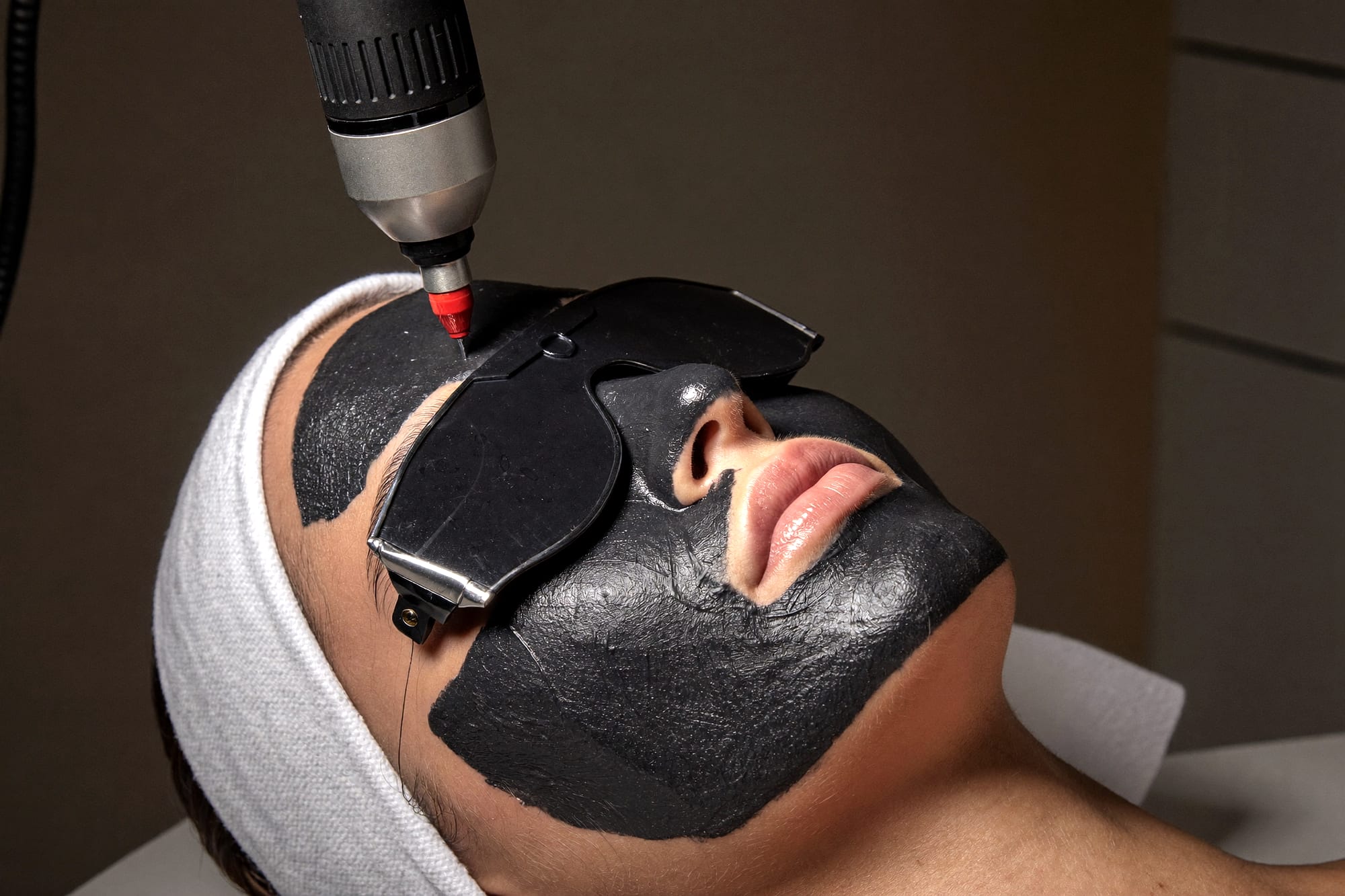 Hollywood Charcoal Peel: black carbon mask, eye shields, and the laser passing over the skin